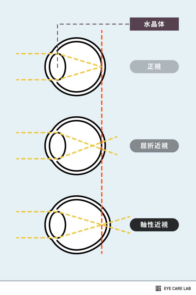 近視の種類